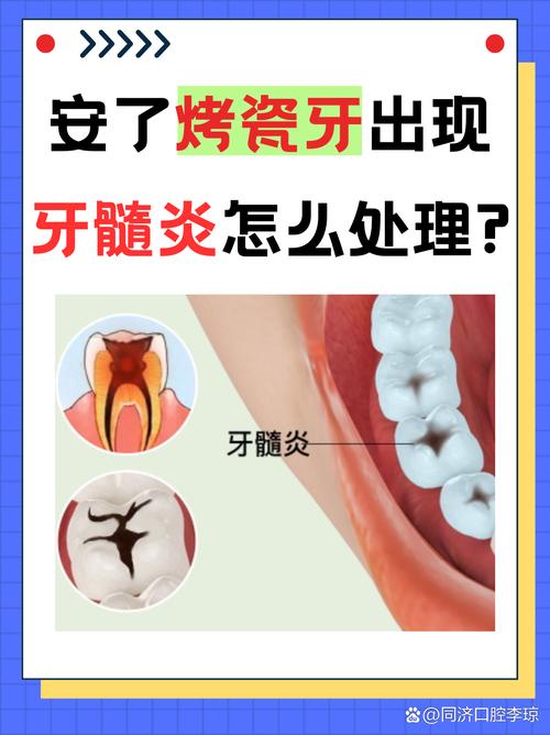 一个牙医的良心忠告烤瓷牙_良心医生建议做烤瓷牙_牙科诊所烤瓷牙一般多少钱