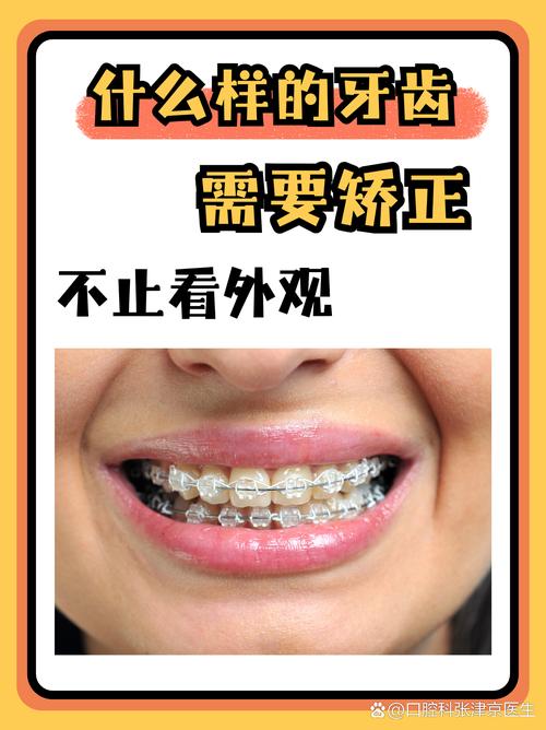南京45岁矫正牙齿还来得及吗？过来人分享3年真实经历，成人正畸必看
