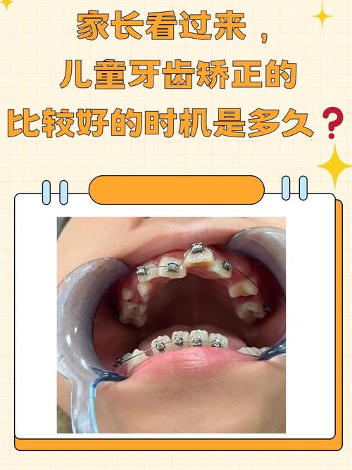 牙齿矫正可以分期付款吗_八岁可以矫正牙齿吗_牙齿矫正可以只矫正几颗吗