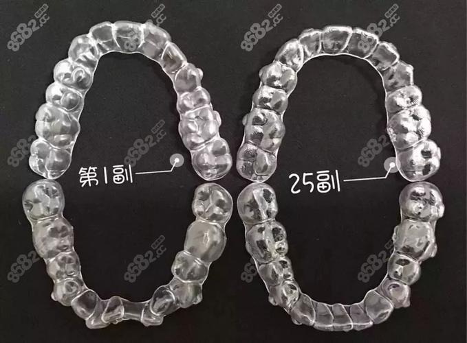 南京深圳隐适美矫正费用全公开 花多少钱心里有数