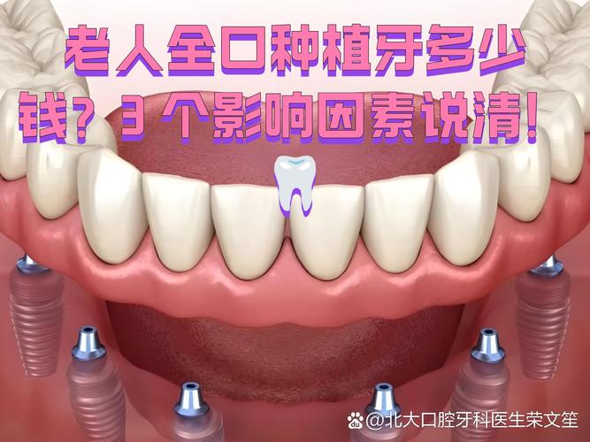 南京深圳老人全口种牙费用明细 深圳全口种植牙价格参考