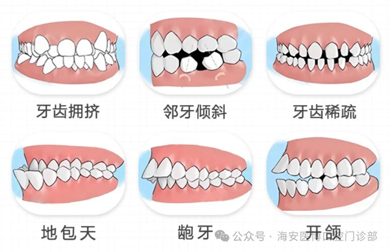 南京成人暴牙正畸要多少钱?价格全攻略来了
