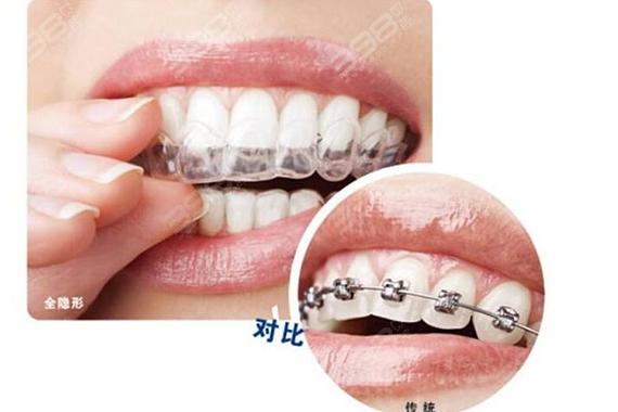 南京牙齿矫正选隐形还是钢丝?看完这篇不纠结