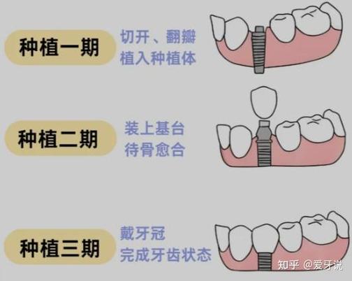 南京杭州种植牙骨粉贵不贵？要补多少？