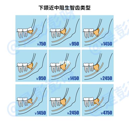 南京杭州口腔医院拔牙要花多少钱？怎么选才不踩坑？