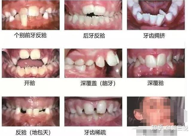 南京青岛儿童几岁做正畸最好？多少钱？