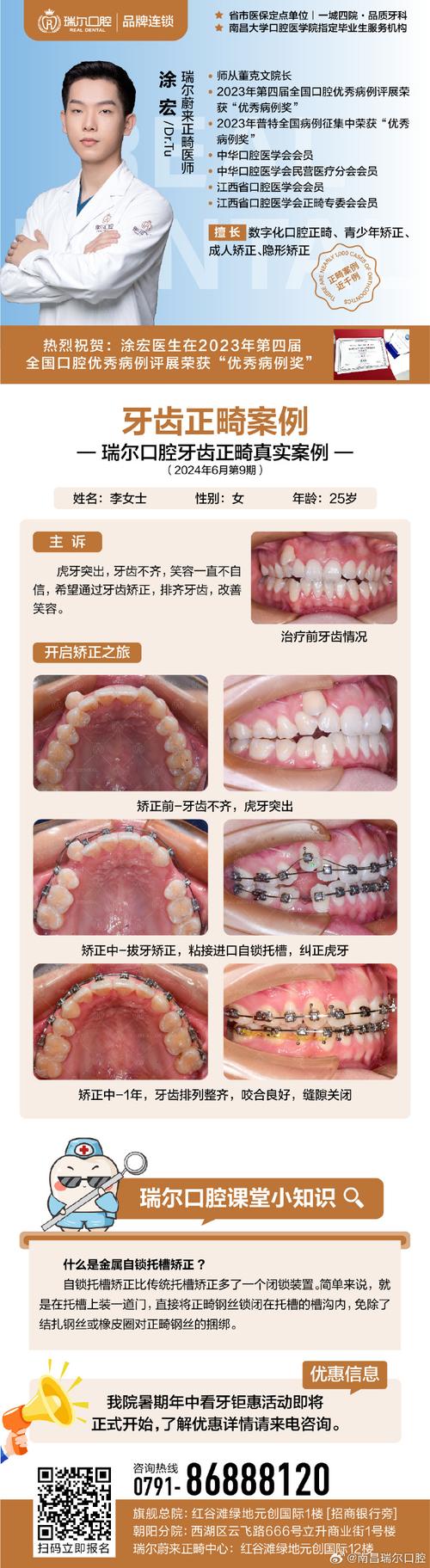 南京成人龅牙矫正选医院还是诊所?关键看医生资质和案例对比
