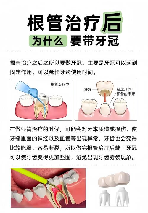 南京根管治疗补牙到底怎么回事?医生详解步骤和必要性