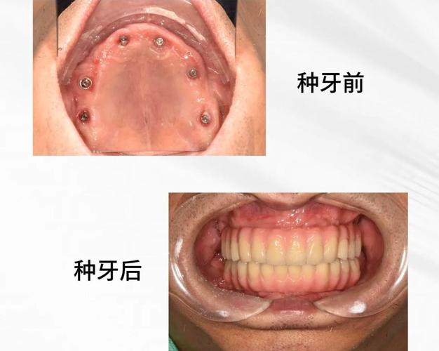种植牙哪些人不能种_种植牙适合人群 禁忌人群 2026_关于种植牙有那些人不适合