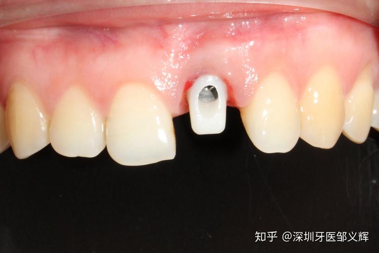 南京大牙坏了还能马上种吗？牙医揭秘即拔即种的真相与风险
