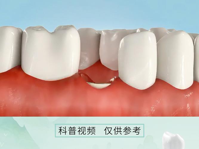 南京福田区根管治疗后必须做牙冠吗