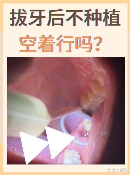 南京成人拔牙后必须种牙吗？不种牙的后果，医生告诉你真相