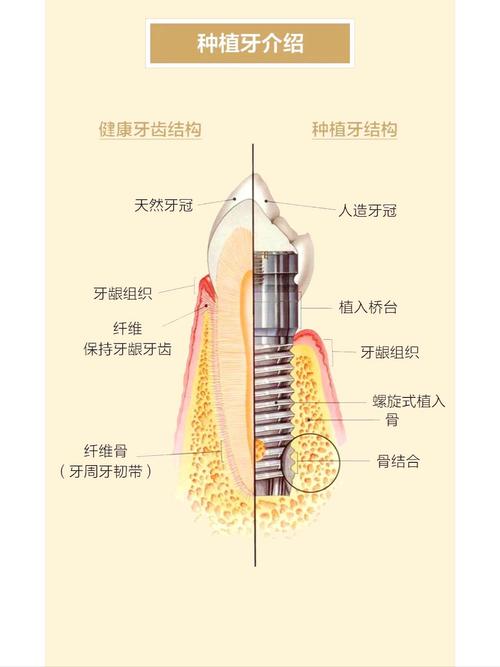 南京什么叫种植牙齿 一篇讲清原理过程