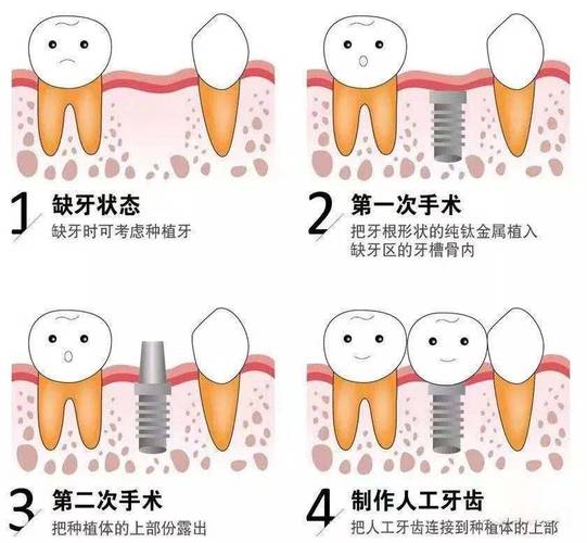 南京上海种植牙全过程揭秘：从挂号到戴牙多久？