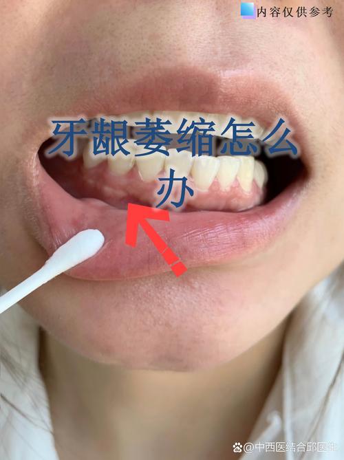 南京缺牙不补的严重后果:邻牙倾斜松动,对牙伸长,牙槽骨萎缩
