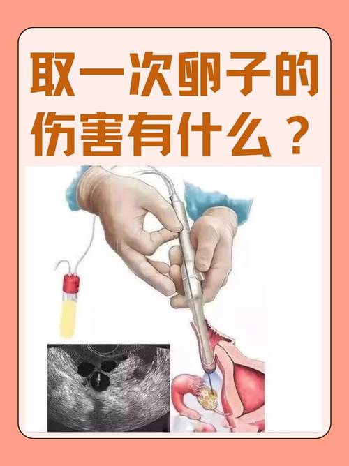 南京取卵麻醉到底疼不疼 会不会影响卵子质量 医生一次说清
