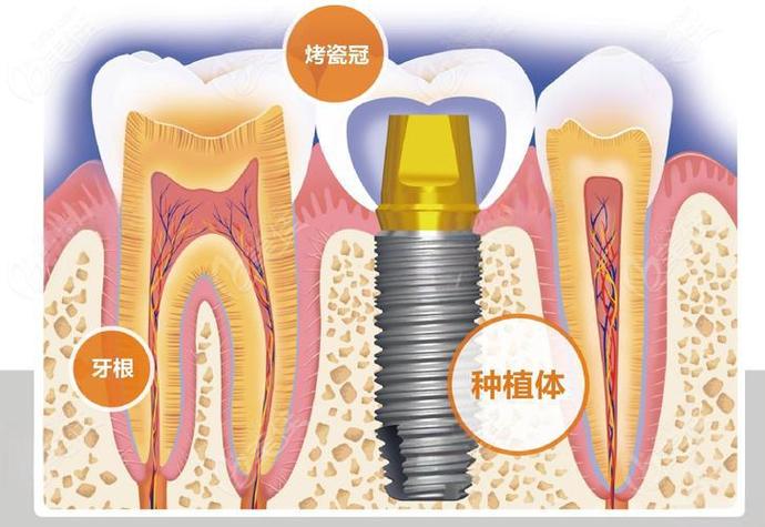 南京赤峰种牙费用详解：从预算到效果，给您的实惠指南