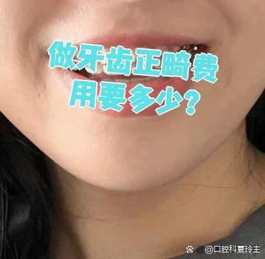 南京深圳福田青少年钢丝矫正牙齿要花多少钱