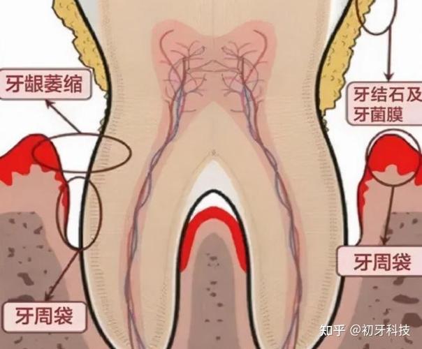 南京贵阳种植牙2026年单颗3500到5500元贵吗