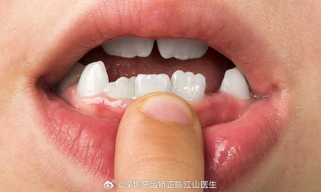 南京小孩牙齿长成锯齿状，到底严重不严重？
