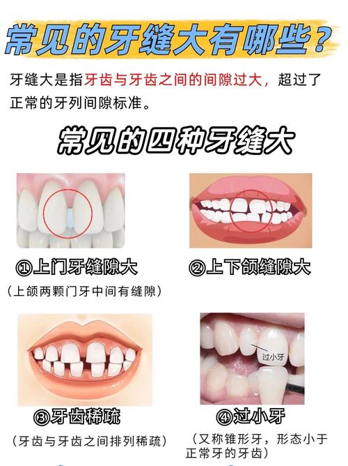 南京矫正牙齿门牙缝隙变大了？医生告诉你正常吗咋应对