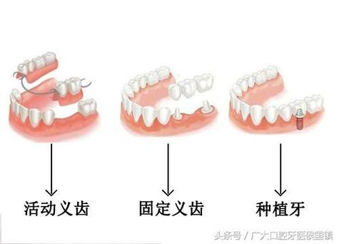 南京北京种牙失败修复多少钱？游离体取出需花费多少？