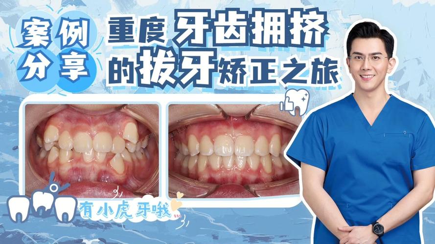 南京告别“虎牙”尴尬,快速矫正重塑自信笑容