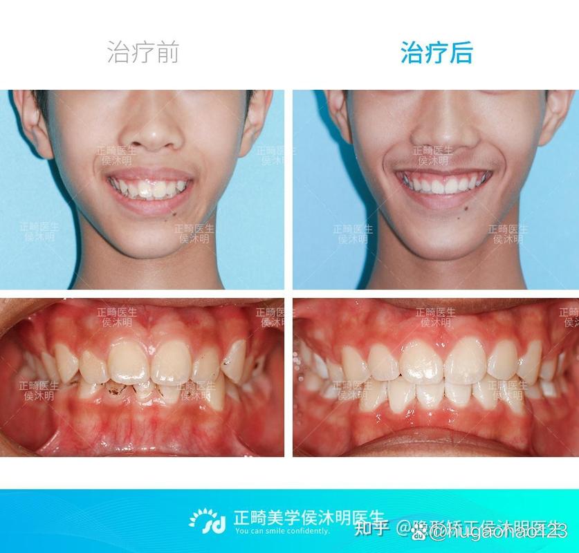 南京25岁龅牙还能矫正吗？过来人分享真实经历