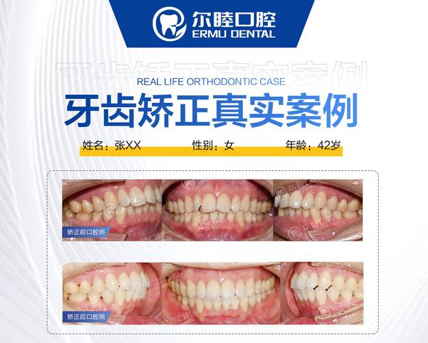 南京深圳宝安换牙矫正多少钱?最新费用参考来了