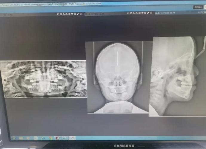 南京幼儿地包天矫正要花多少钱?费用明细来了