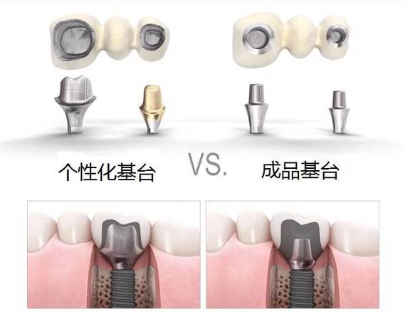 南京缺牙后选进口还是国产种植体？到底哪个更划算？