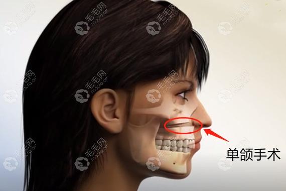 南京深圳成人骨性龅牙矫正到底要花多少钱？