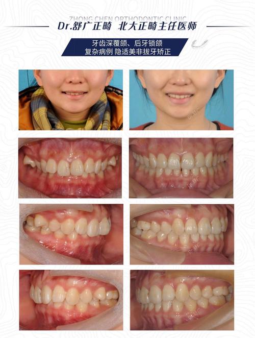 南京30岁后矫正深覆合?成人正畸完全可行