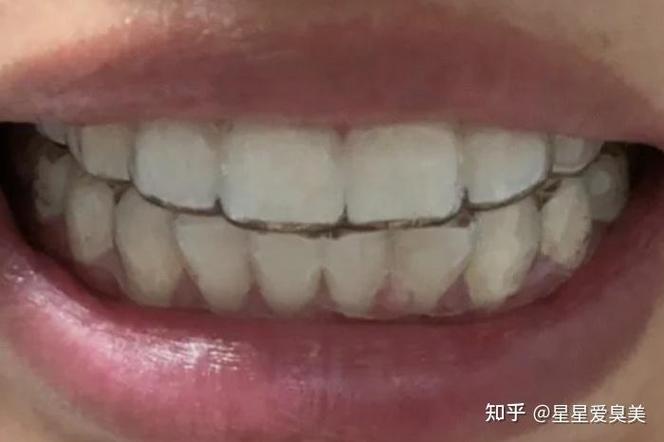 南京牙齿矫正30岁开始晚吗?过来人分享真实经历与经验