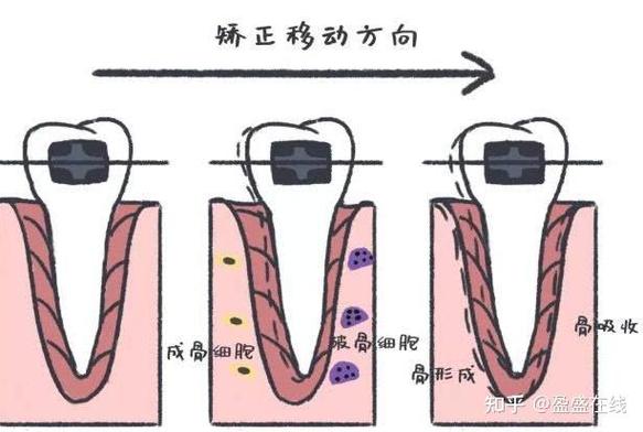 南京23岁做牙齿矫正晚不晚？过来人分享真实经历