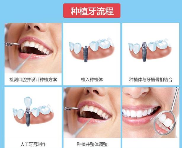 南京深圳罗湖骨量不足全口种牙多少钱?费用明细来了