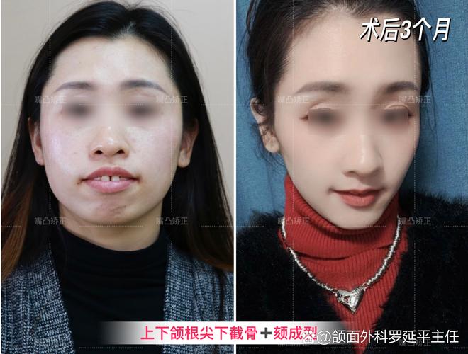 南京凸嘴矫正真能靠整牙改变?来看真实效果