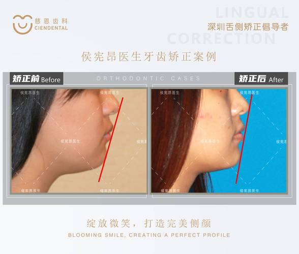 南京为什么24岁做牙齿矫正效果更好