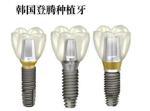 南京株洲种牙哪家强？公立医院性价比之选