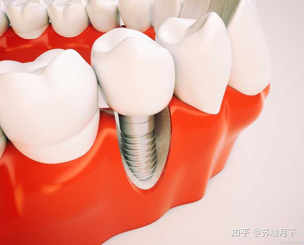 南京深圳登腾全套餐牙科医院怎么选？种牙经验分享