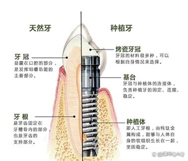 南京深圳缺牙修复：镶牙与种植牙到底哪个更省钱？