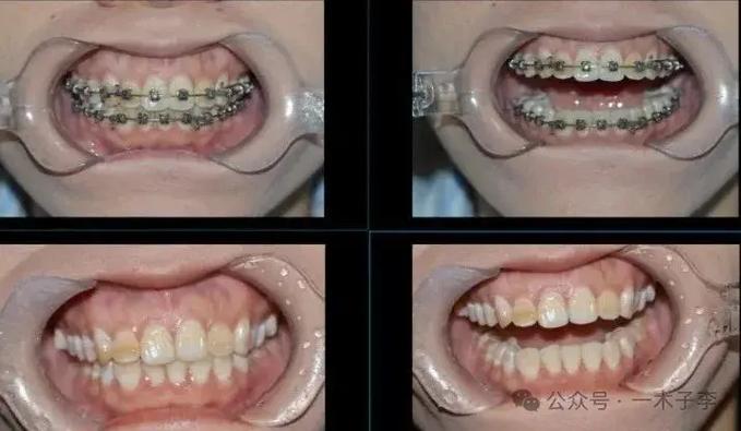 南京30岁矫正牙齿有什么危害?把坑说透了再决定