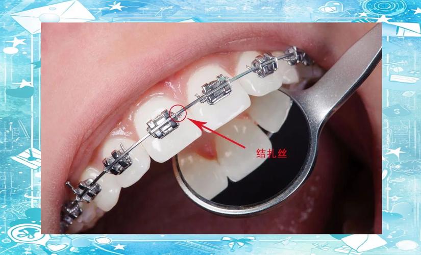 南京牙齿矫正哪种方法好？从效果和舒适度来对比