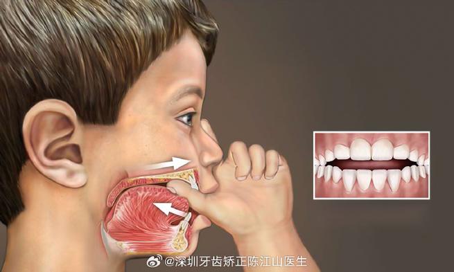 南京深圳孩子地包天几岁治最好?牙医揭秘黄金期