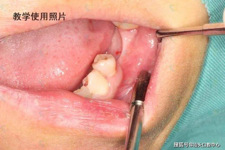 南京没有牙骨也能种牙？医生说实话