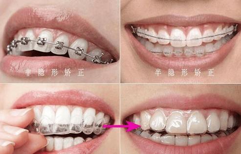 南京25岁还能矫正牙齿吗?看完这篇不再纠结