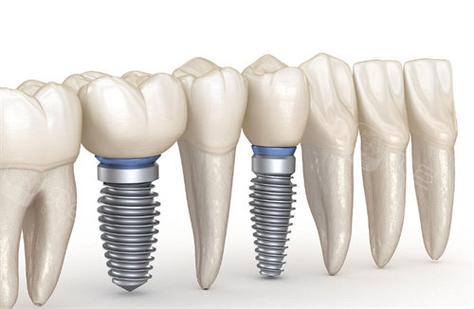 南京成都种牙2026年最新报价：单颗2700到5000元靠谱吗？