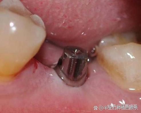 南京深圳高血压糖尿病人能种牙吗？医生实话：控好指标就能种