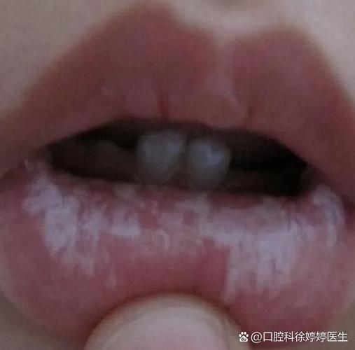 南京儿童口腔有白色黏膜到底严不严重