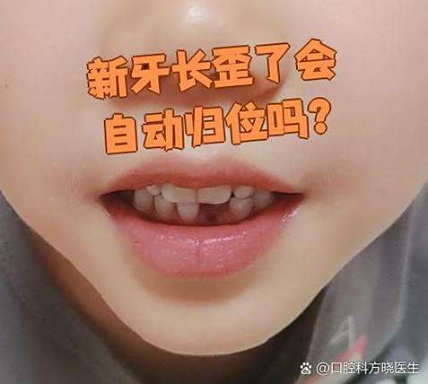 南京六岁孩子门牙长歪先别慌 看这几种矫正办法